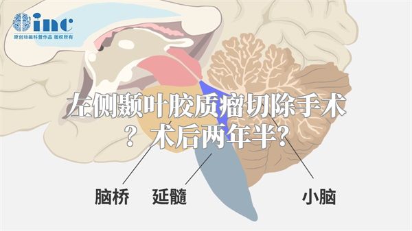 左侧颞叶胶质瘤切除手术？术后两年半？