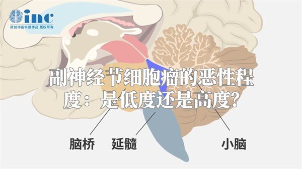 副神经节细胞瘤的恶性程度：是低度还是高度？