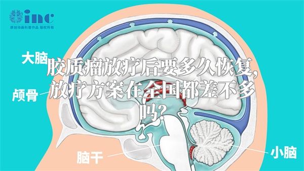 胶质瘤放疗后要多久恢复，放疗方案在全国都差不多吗？