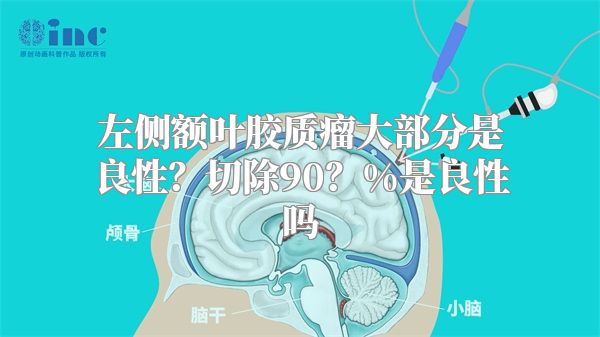 左侧额叶胶质瘤大部分是良性？切除90？%是良性吗