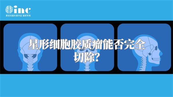 星形细胞胶质瘤能否完全切除？