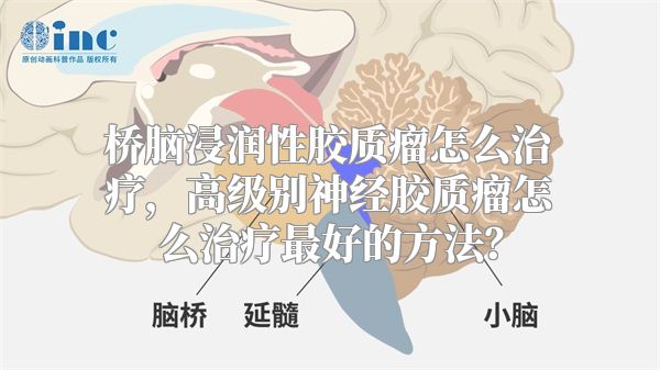 桥脑浸润性胶质瘤怎么治疗，高级别神经胶质瘤怎么治疗最好的方法？