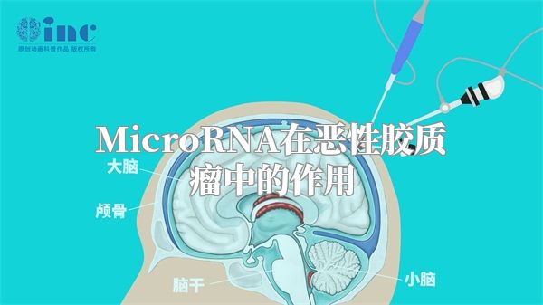 MicroRNA在恶性胶质瘤中的作用