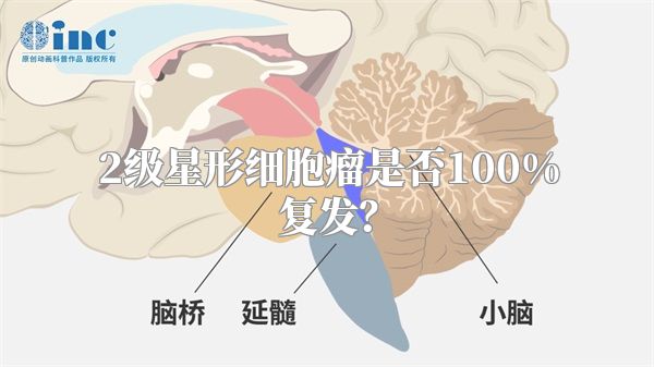 2级星形细胞瘤是否100%复发？