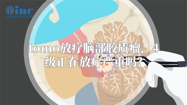 tomo放疗脑部胶质瘤，4级正在放疗严重吗？