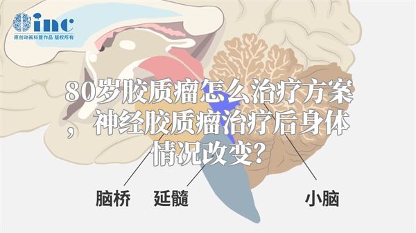 80岁胶质瘤怎么治疗方案，神经胶质瘤治疗后身体情况改变？