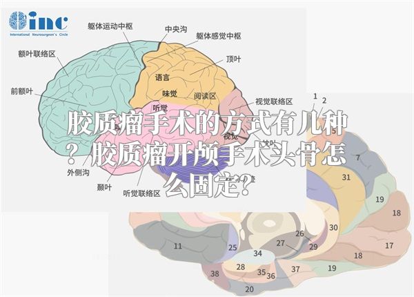 胶质瘤手术的方式有几种？胶质瘤开颅手术头骨怎么固定？