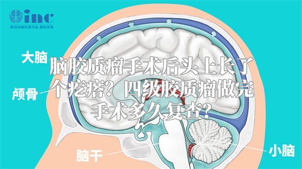 脑胶质瘤手术后头上长了个疙瘩？四级胶质瘤做完手术多久复查？