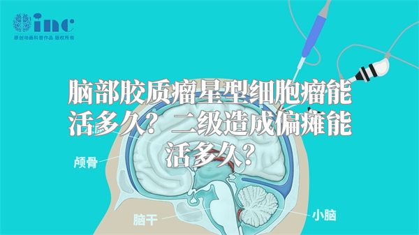 脑部胶质瘤星型细胞瘤能活多久？二级造成偏瘫能活多久？