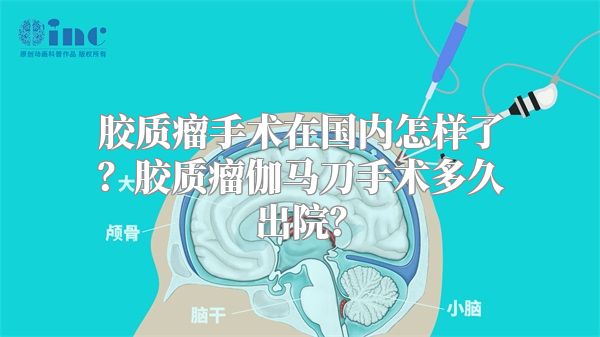 胶质瘤手术在国内怎样了？胶质瘤伽马刀手术多久出院？