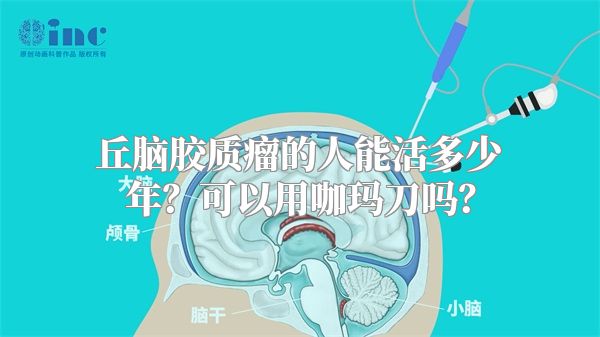 丘脑胶质瘤的人能活多少年？可以用咖玛刀吗？