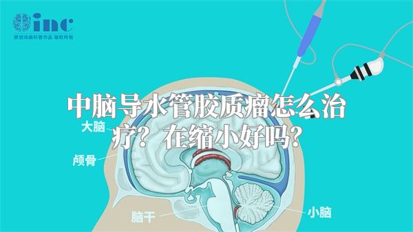 中脑导水管胶质瘤怎么治疗？在缩小好吗？