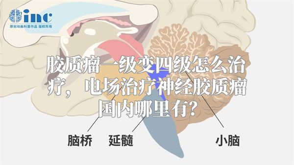 胶质瘤一级变四级怎么治疗，电场治疗神经胶质瘤国内哪里有？