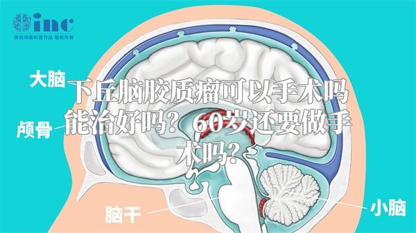 下丘脑胶质瘤可以手术吗能治好吗？60岁还要做手术吗？