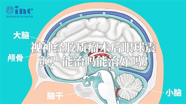 视神经胶质瘤术后眼球震颤？能治吗能治好吗？