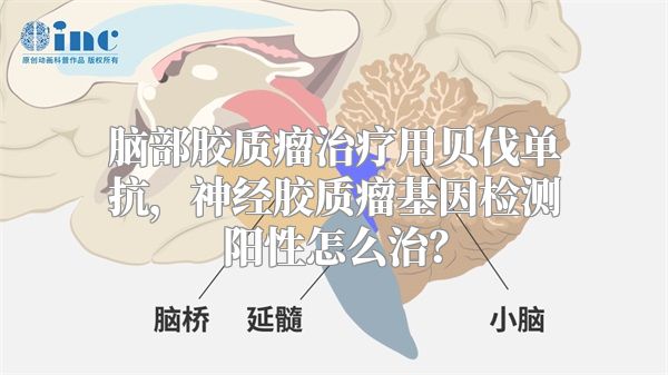 脑部胶质瘤治疗用贝伐单抗，神经胶质瘤基因检测阳性怎么治？