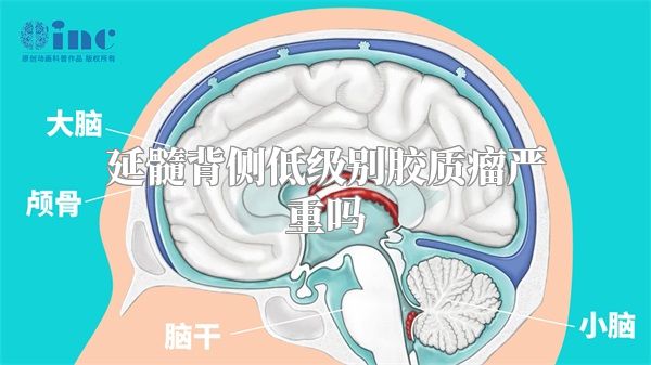 延髓背侧低级别胶质瘤严重吗