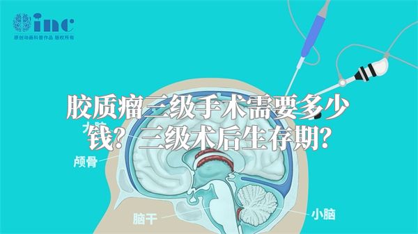 胶质瘤三级手术需要多少钱？三级术后生存期？