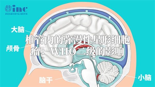 椎管内的弥漫性星形细胞瘤：WHO二级的影响