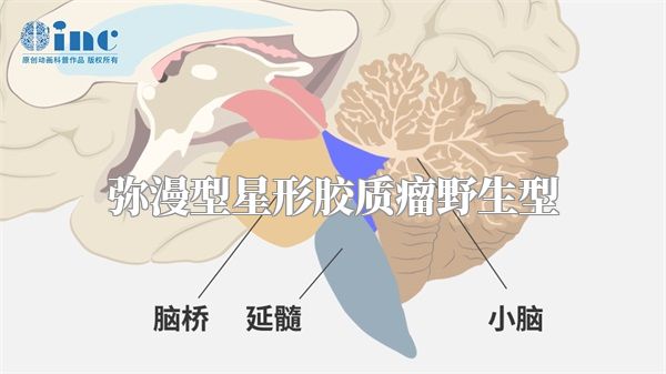 弥漫型星形胶质瘤野生型