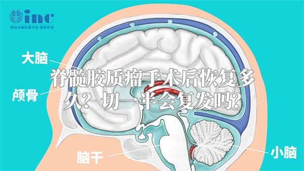 脊髓胶质瘤手术后恢复多久？切一半会复发吗？