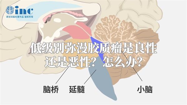 低级别弥漫胶质瘤是良性还是恶性？怎么办？