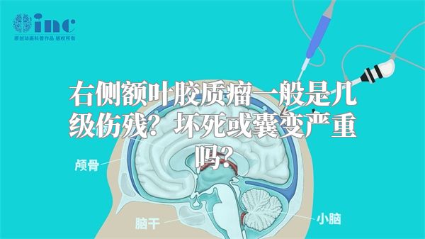 右侧额叶胶质瘤一般是几级伤残？坏死或囊变严重吗？