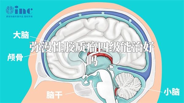 弥漫性胶质瘤四级能治好吗