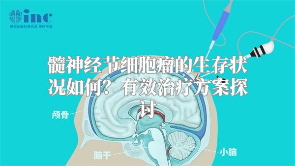 髓神经节细胞瘤的生存状况如何？有效治疗方案探讨