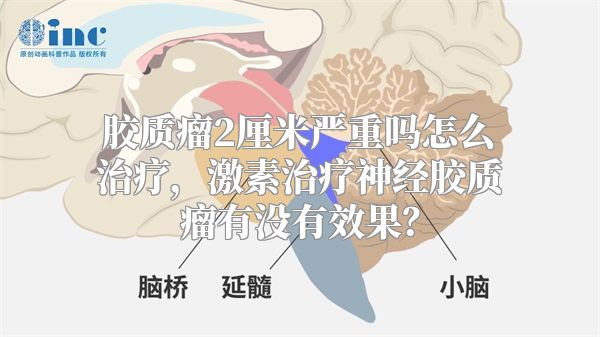 胶质瘤2厘米严重吗怎么治疗，激素治疗神经胶质瘤有没有效果？