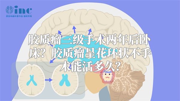 胶质瘤三级手术两年后卧床？胶质瘤呈花环状不手术能活多久？