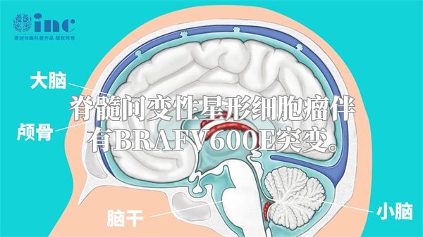 脊髓间变性星形细胞瘤伴有BRAFV600E突变。