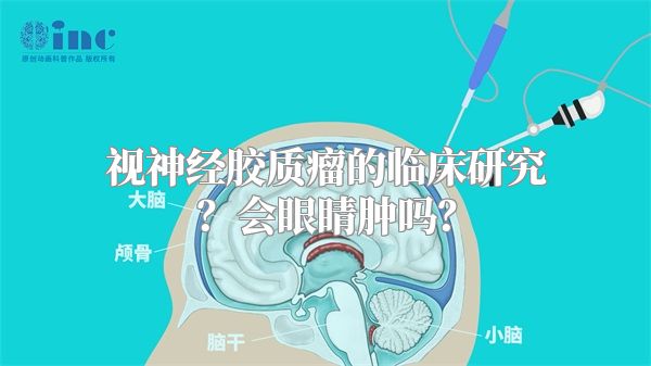 视神经胶质瘤的临床研究？会眼睛肿吗？