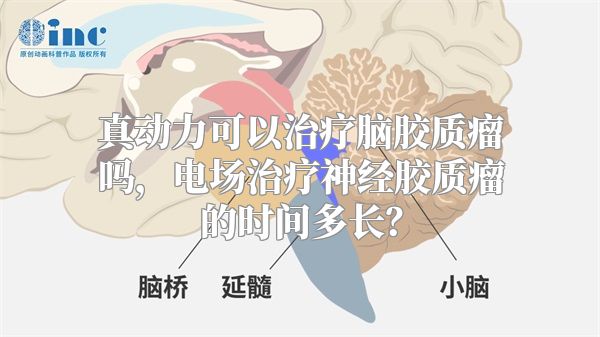 真动力可以治疗脑胶质瘤吗，电场治疗神经胶质瘤的时间多长？