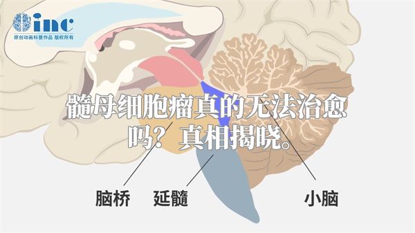 髓母细胞瘤真的无法治愈吗？真相揭晓。