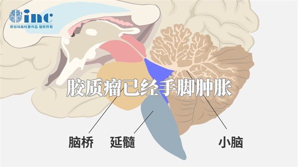 胶质瘤已经手脚肿胀