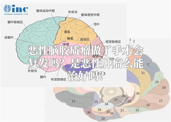 恶性脑胶质瘤做了手术会复发吗？是恶性肿瘤么能治好吗？