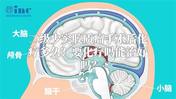 二级少突胶质瘤手术后化疗多久？要化疗吗能治好吗？