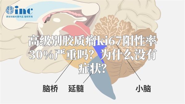 高级别胶质瘤ki67阳性率30%严重吗？为什么没有症状？