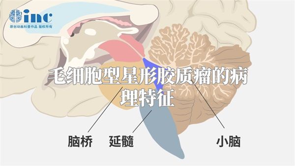 毛细胞型星形胶质瘤的病理特征