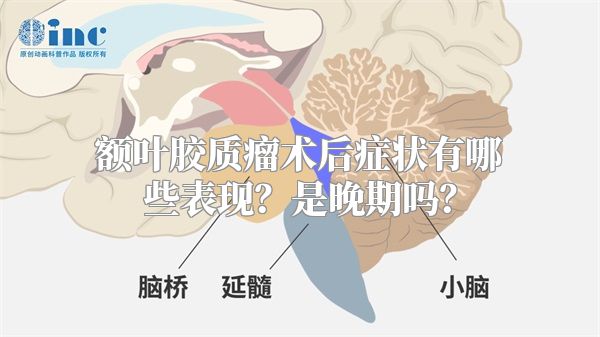 额叶胶质瘤术后症状有哪些表现？是晚期吗？