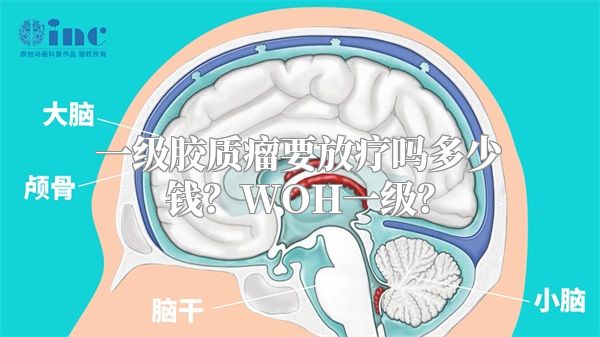 一级胶质瘤要放疗吗多少钱？WOH一级？