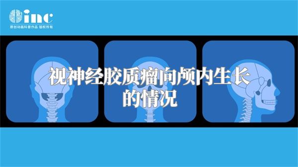 视神经胶质瘤向颅内生长的情况