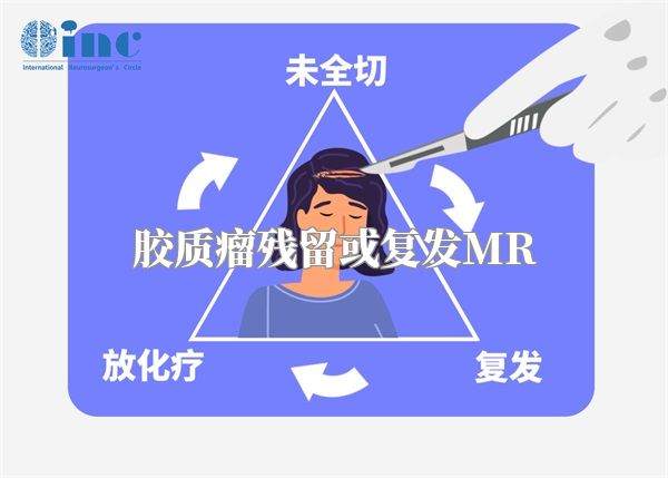 胶质瘤残留或复发MR