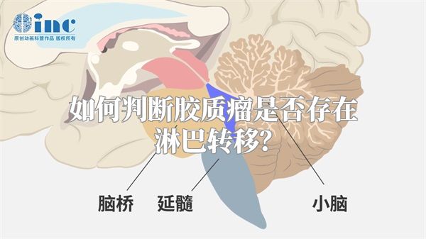 如何判断胶质瘤是否存在淋巴转移？