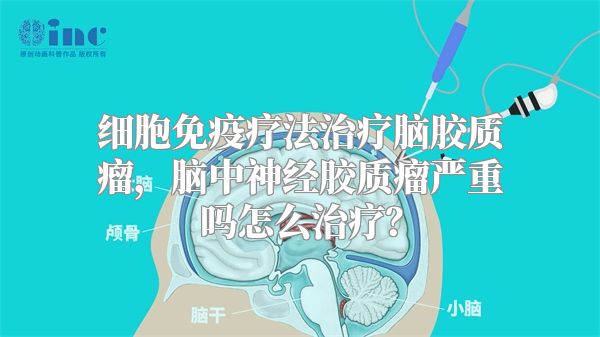 细胞免疫疗法治疗脑胶质瘤，脑中神经胶质瘤严重吗怎么治疗？