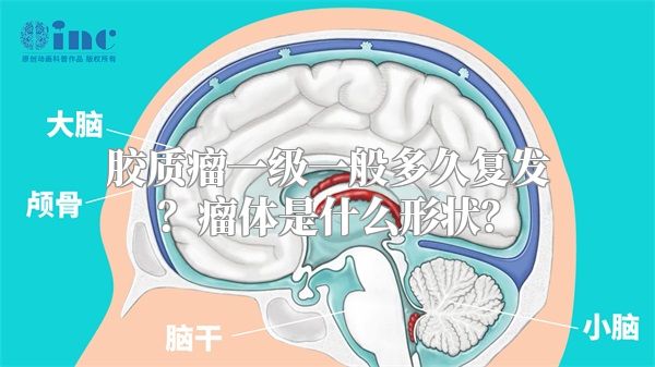 胶质瘤一级一般多久复发？瘤体是什么形状？