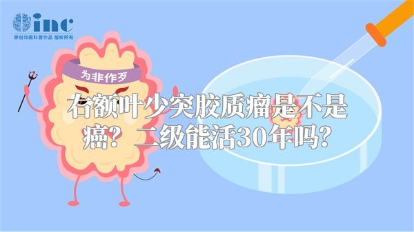 右额叶少突胶质瘤是不是癌？二级能活30年吗？