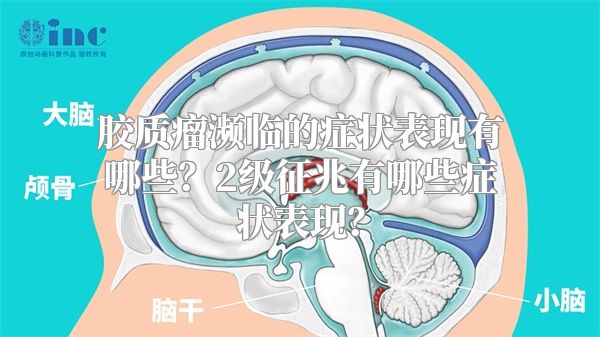 胶质瘤濒临的症状表现有哪些？2级征兆有哪些症状表现？