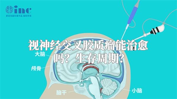 视神经交叉胶质瘤能治愈吗？生存周期？